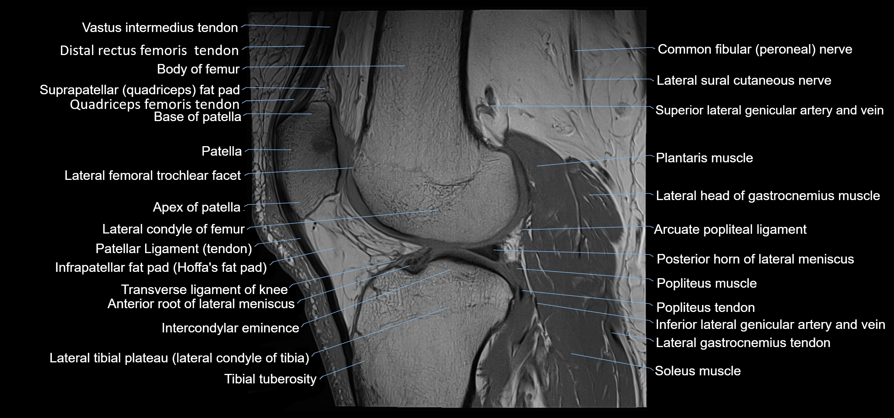 MRI knee sagittal cross sectional anatomy labelled 3T radiology image-00030.webp